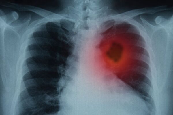 Top 10 Leading Causes of Cancer & Cancer Deaths Exposed